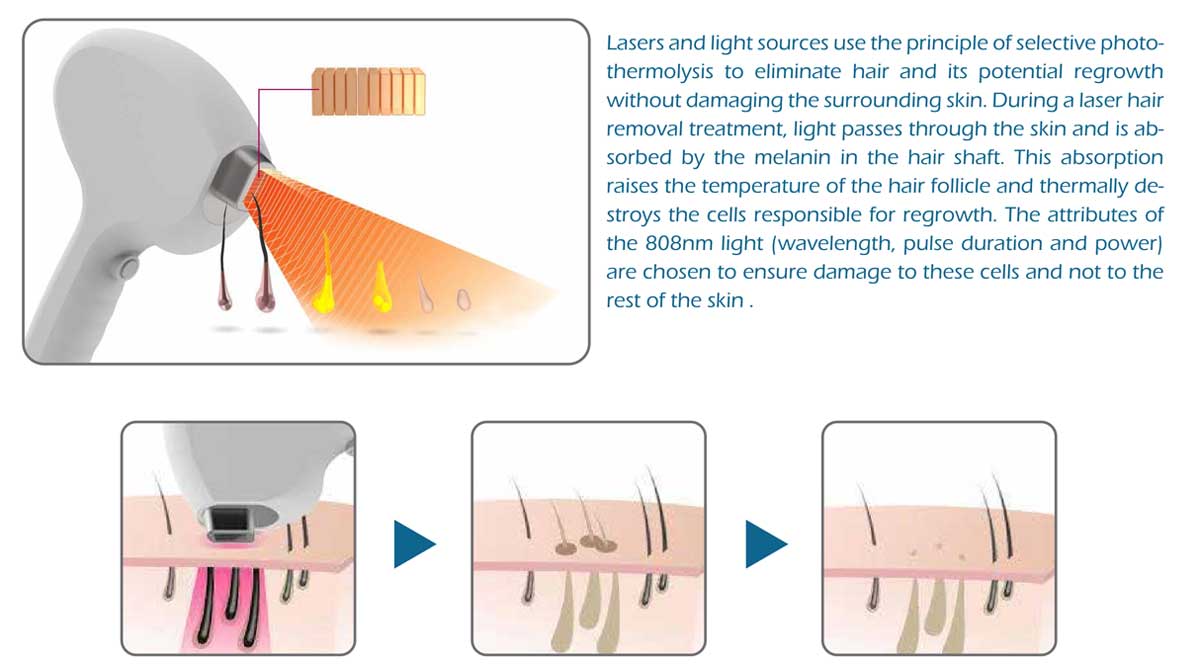 808nm Diode Laser Machine Treatment Principle