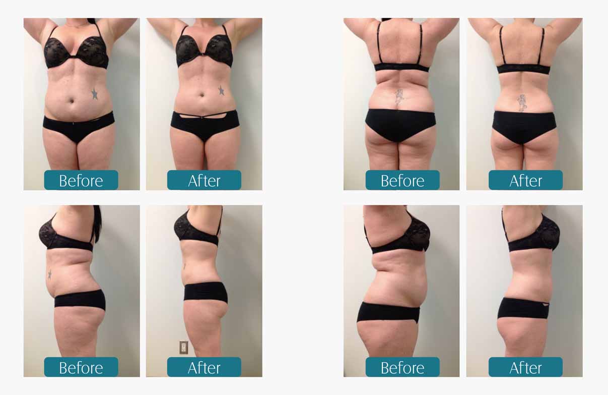 Cryolipolysis Slimming Machine LB-C2P before and after