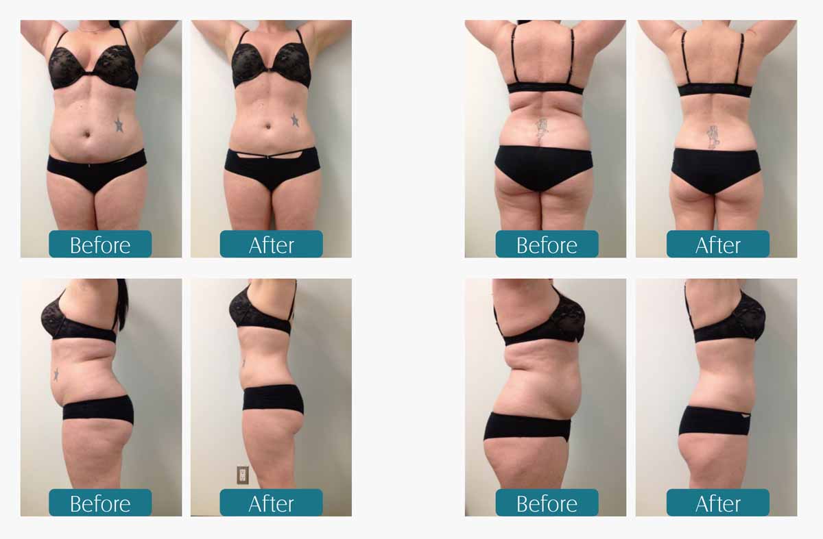 Cryolipolysis Slimming Machine before and after