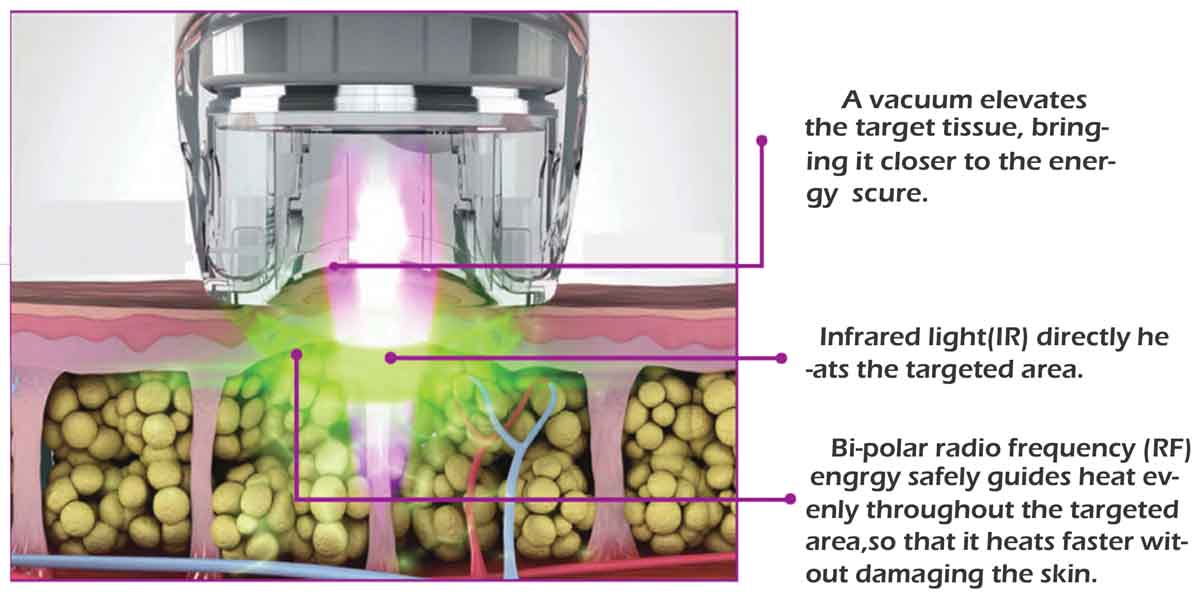 Infrared FR Vacuum Cavitation Roller Slimming Machine Treatment Principle